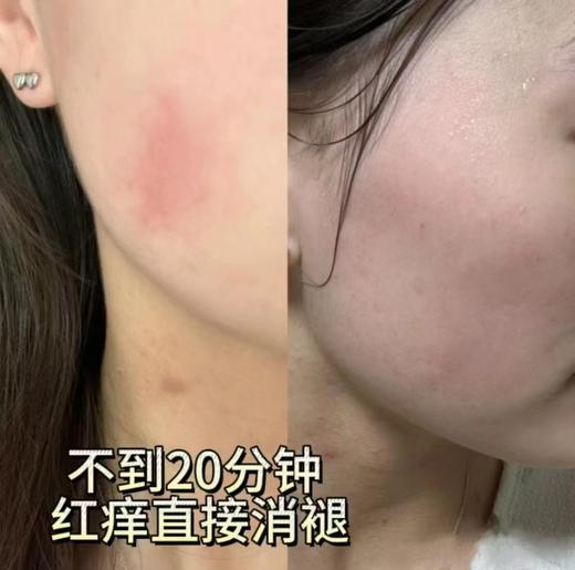 妃童尔语-医用重组川型人源化胶原蛋白敷料(械二) 医用面膜冷敷贴5片/盒 商品图2