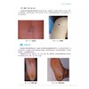 常见体表肿瘤切除及修复 宣庆元主编 适合于整形外科皮肤科普通外科肿瘤外科及其他相关科室医师阅读的参考书 辽宁科学技术出版社 商品缩略图4