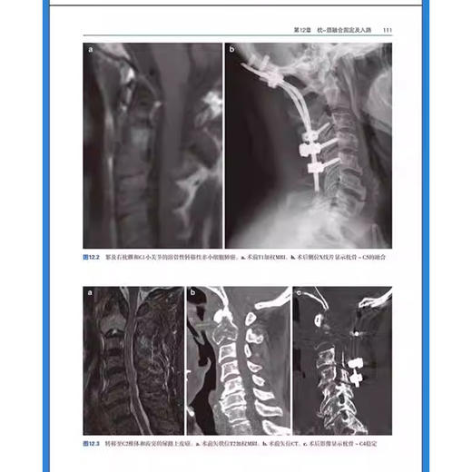 脊柱肿瘤手术 基于病例的方法 黄霖 秦毅 周文钰 陈铿 主译 前路手术后路手术硬膜内入路 9787559137265辽宁科学技术出版社 商品图3