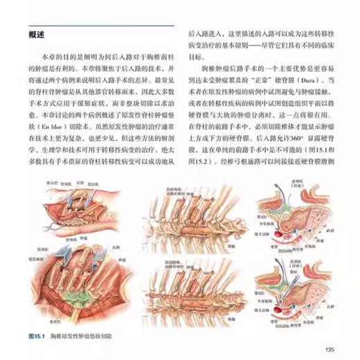 脊柱肿瘤手术 基于病例的方法 黄霖 秦毅 周文钰 陈铿 主译 前路手术后路手术硬膜内入路 9787559137265辽宁科学技术出版社 商品图4