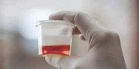  尿液出现这种颜色，一定别掉以轻心，可能是癌症！ 