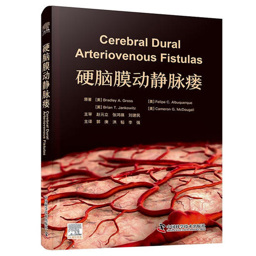 硬脑膜动静脉瘘 商品图0