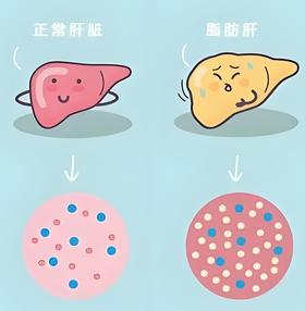  体检发现脂肪肝如何应对？这样做可以逆转！ 