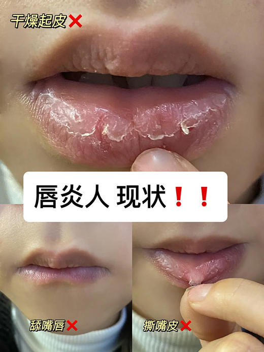 正品带防伪【香港大药房唇炎型医用凝胶】 吊打一切唇膏‼线下①支89元！我们②支29.90元 拯救顽固唇炎、软化死皮、改善干裂、淡化唇纹，还你健康嘟嘟唇 🔺0酒精 0香精 0激素❌不含任何化学添加剂 商品图2