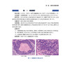 临床病理学典型案例诊断图谱 临床病理住院医师规范化培训实践系列教材 应建明 石素胜 杨琳主编 人民卫生出版社9787117356084 商品缩略图4