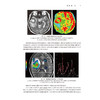 脑部分册 临床磁共振成像系列丛书 程敬亮 文宝红 张勇 主编 涵盖了脑部绝大部分常见和少见疾病相关临床知识和磁共振征象等 商品缩略图4