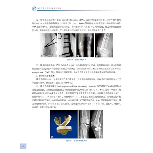膝关节骨性关节炎截骨与置换 史宝明黄海 介绍了截骨保膝手术 单髁置换及全膝关节置换三种手术方式 骨伤医学书科学技术文献出版社 商品图4