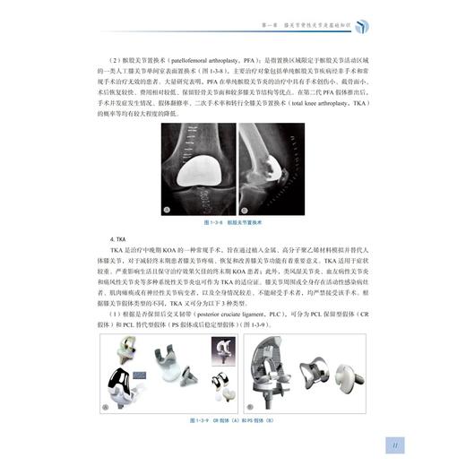 膝关节骨性关节炎截骨与置换 史宝明黄海 介绍了截骨保膝手术 单髁置换及全膝关节置换三种手术方式 骨伤医学书科学技术文献出版社 商品图3
