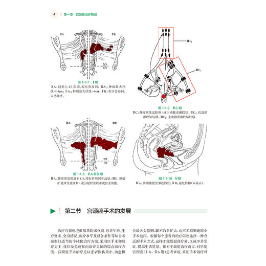 全2册 卵巢癌手术图解 + 宫颈癌手术难点与技巧图解（第2版）卵巢癌诊治指南黏液性瘤子宫内膜样瘤临床手术步骤视频腹腔镜  商品图4