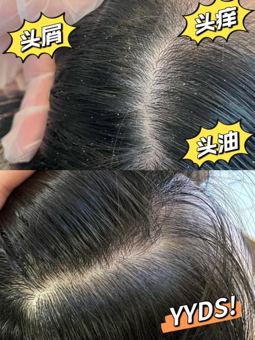专业头屑吸尘器韩水仙头屑宁头皮素 商品图12