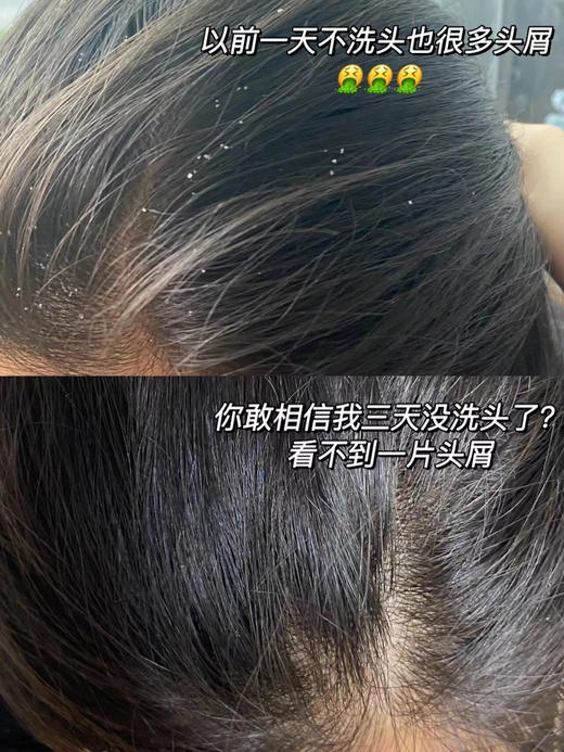 专业头屑吸尘器韩水仙头屑宁头皮素 商品图11