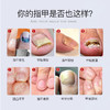 【专利靶向去灰甲】Breathy布雷辛灰甲液 有机植物精油配方 深层渗透甲根 源头解决指甲问题 无痛 不拔甲 商品缩略图2