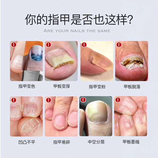 【专利靶向去灰甲】Breathy布雷辛灰甲液 有机植物精油配方 深层渗透甲根 源头解决指甲问题 无痛 不拔甲 商品图2