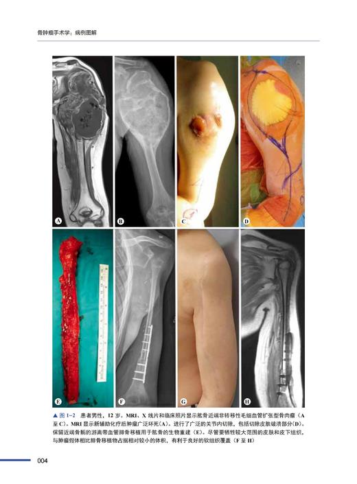 骨肿瘤手术学：病例图解 商品图3