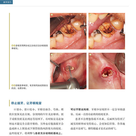 全2册 拔牙技巧+阻生智齿拔除术视频图谱--涡轮钻法 第2版 口腔医学书籍 拔牙方法手法麻醉处置应对 口腔科学 辽宁科学技术出版社 商品图4