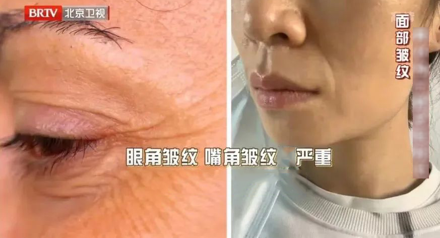 皱纹.png