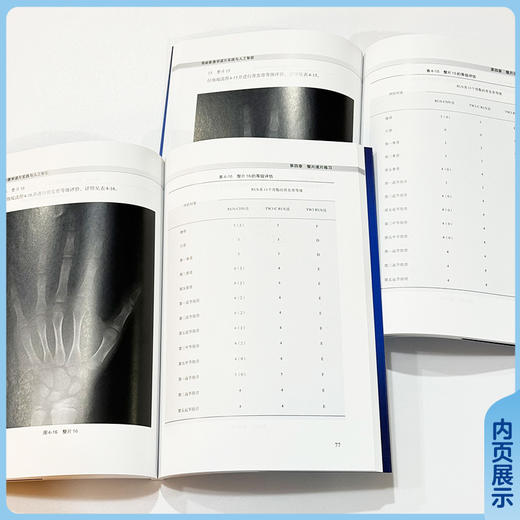 骨龄影像学读片实践与人工智能 程晓光 编 系统解析RUS-CHN、TW3-C RUS和TW3 RUS法骨发育等级评估标准等 中国协和医科大学出版社 商品图4