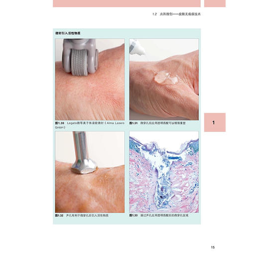 图解富血小板血浆（PRP）微针再生美容实用指南(德)伯纳德·C.科尔斯特 主编 附加内容二维码 9787559140579辽宁科学技术出版社 商品图3