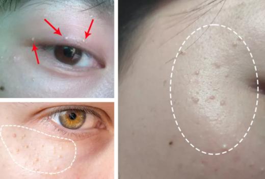 1支/2支【 升级版】日本去脂肪粒眼霜眼周专用精华液8g/支 A-4425 商品图3