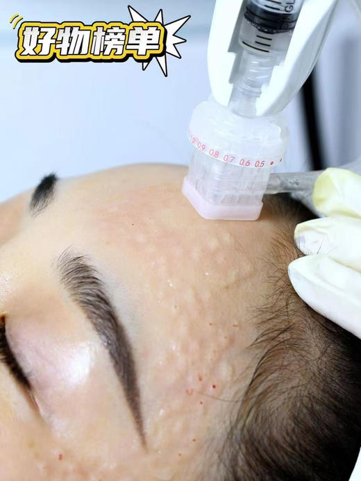 戴澳思无菌水光9针头单支 带刻度可调节 水光针九针头 商品图9