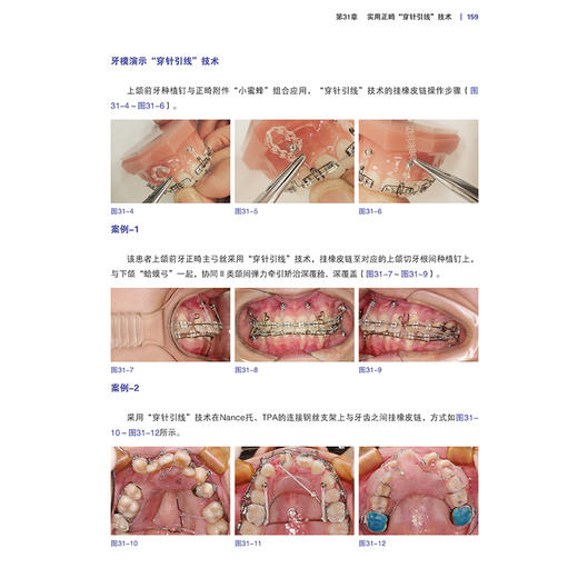 实用口腔正畸小妙招 武广增 主编 涵盖35种临床病例类型 配合千余张临床照片及操作示意图 辽宁科学技术出版社9787559141378 商品图4