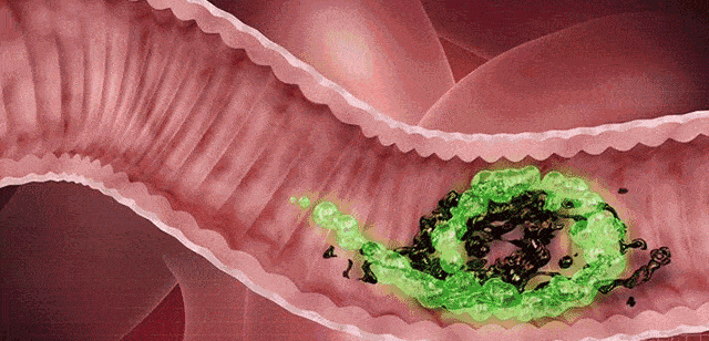 【惊爆！】 五个人中就有一个人有这个问题！小心变成癌！