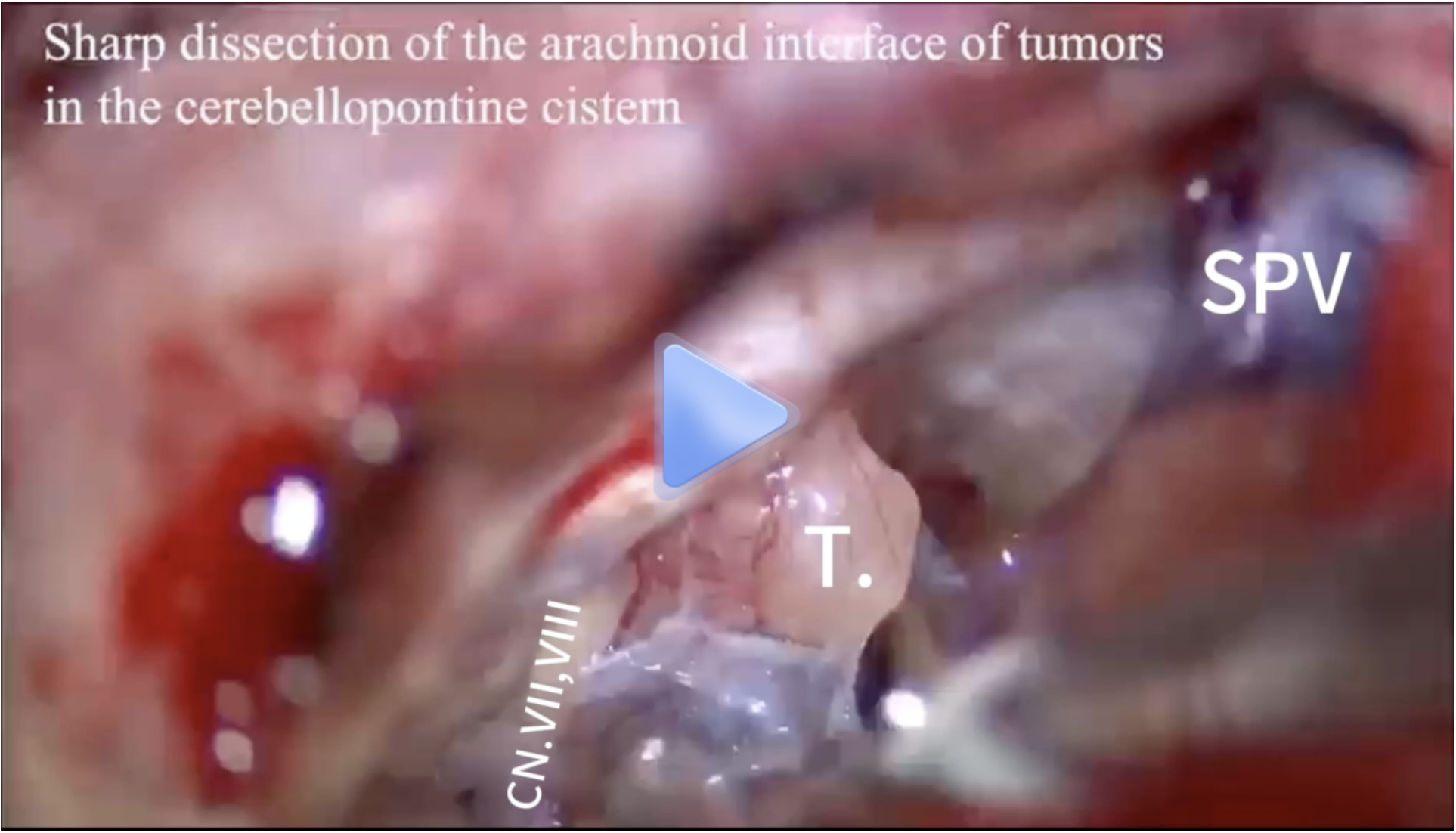 听瘤显微操作部分