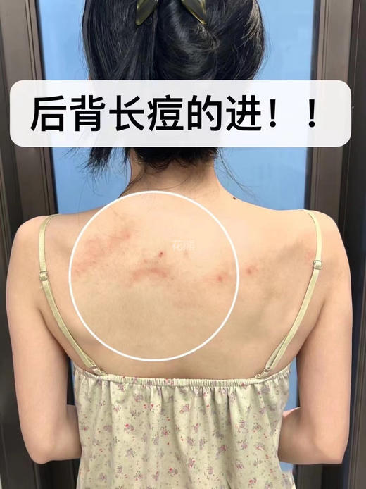 【Dr.RK仁康博士除螨皂液】夏天直接吊带自由!背后痘痘终于有救了 日本。专业团队悉心精研“去螨率99.99% 型有效显著祛痘28天持续改善 1瓶=保湿+除螨+袪痘+留香四四效合一 商品图1