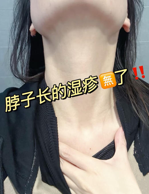 【百想皮小青膏】拔毒止痒效果爆好 小分子结构，渗透力强，温和不刺激! 针对瘙痒、皮炎、湿疹、过敏、手足癣、股癣、脚气 商品图2