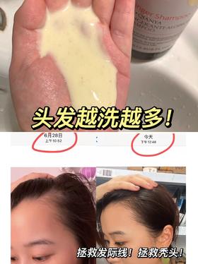 🌿【五步打造健康头皮】卓蓝雅生姜防脱固发养护全攻略（养发馆同流程家庭版）