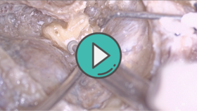 轮廓化半规管 视频