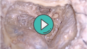 剪除前庭上下神经进一步磨开内听道底部