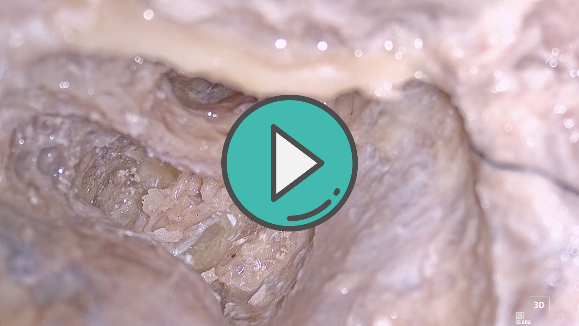 剪开内听道内硬膜直视前庭上下神经