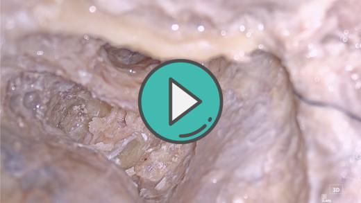 剪开内听道内硬膜直视前庭上下神经 商品图0