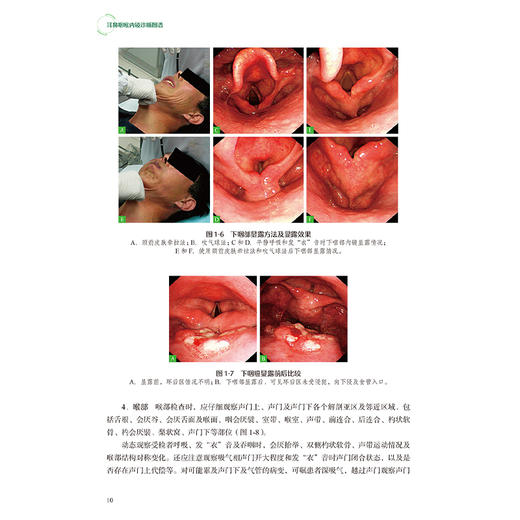 耳鼻咽喉内镜诊断图谱 于振坤 张永辉 倪晓光 介绍了耳鼻咽喉科内镜的分类临床应用等 涵盖了耳鼻咽喉科的全部疾病 人民卫生出版社 商品图4