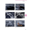 超声引导下的神经阻滞技术 李建华 周谋望 痉挛患者临床治疗肉毒毒素苯酚外科手术干预冷冻神经 辽宁科学技术出版社 商品缩略图4