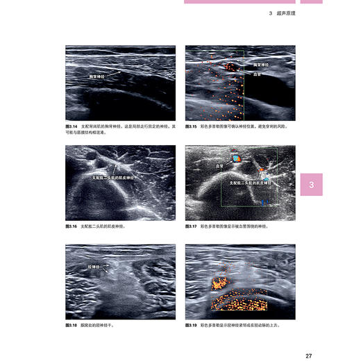 超声引导下的神经阻滞技术 李建华 周谋望 痉挛患者临床治疗肉毒毒素苯酚外科手术干预冷冻神经 辽宁科学技术出版社 商品图4
