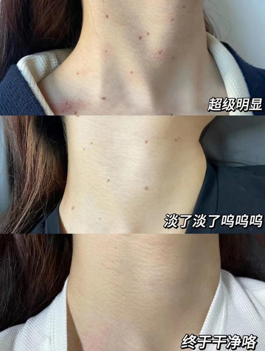 优选丨[升级版]美人姬角质粒软化啫喱系列去脂肪粒汗管粒小肉芽扁平疣温和剥落软化修护 商品图6