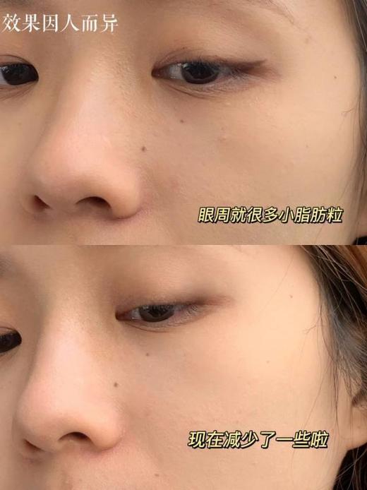 优选丨[升级版]美人姬角质粒软化啫喱系列去脂肪粒汗管粒小肉芽扁平疣温和剥落软化修护 商品图5