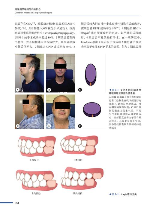 呼吸相关睡眠外科新概念 商品图3
