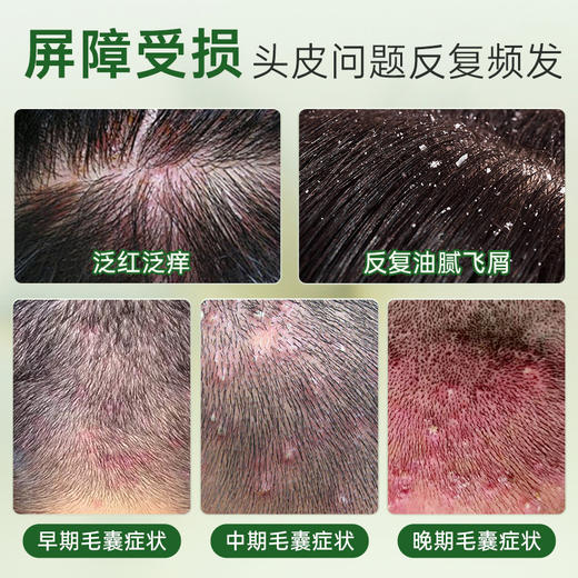 百年扁氏艾草止痒头皮素 商品图1