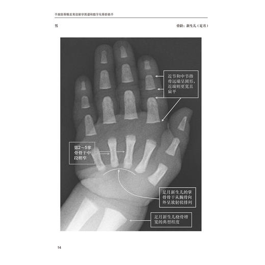 手腕部骨骼发育放射学图谱和数字化骨龄助手 潘慧 王凤丹 杜函泽 主译 手 腕关节 骨骼测量 放射学 图谱 北京大学医学出版社 商品图3