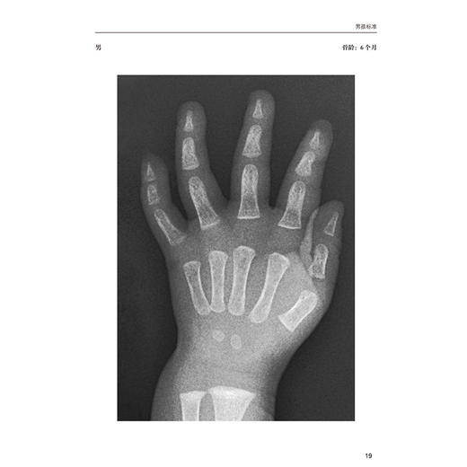 手腕部骨骼发育放射学图谱和数字化骨龄助手 潘慧 王凤丹 杜函泽 主译 手 腕关节 骨骼测量 放射学 图谱 北京大学医学出版社 商品图4