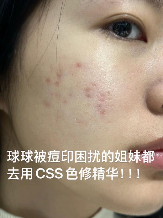 CSS希妍CUI亮肤保湿祛痘印色修精华液 商品图7