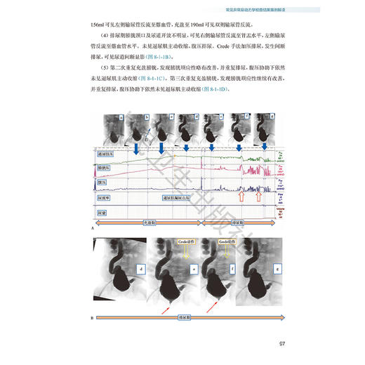 小儿尿动力学检查图解 文建国 内容包括尿流曲线膀胱压力容积测定膀胱压力尿道压力测定异常曲线及特殊曲线解读 人民卫生出版社 商品图4