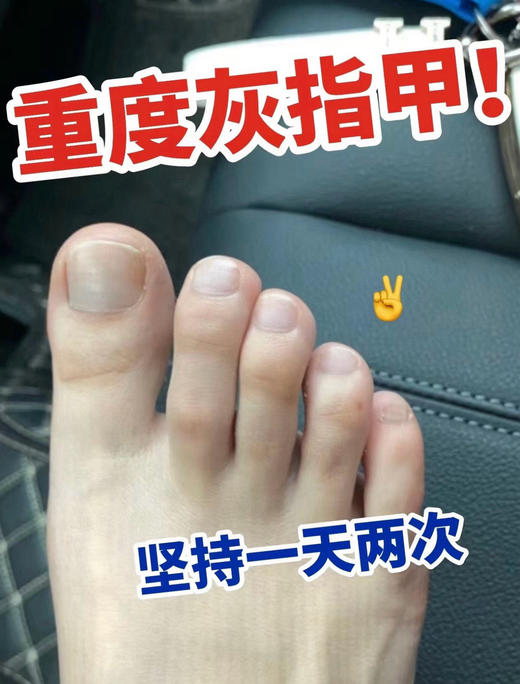 【百想皮泰国 灰甲膏】一抹即消，99%抑菌率十强渗透十长时效 8大草本搭配“醋酸氯已定"科学杀菌 商品图2