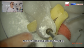 磨除介绍及教学