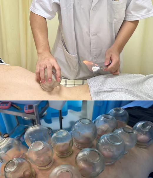 中医拔罐 1次（仅到黄村社卫使用） 商品图0