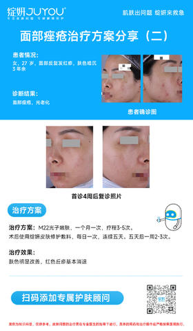 面部痤疮治疗方案分享（二）