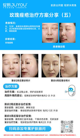 玫瑰痤疮治疗方案分享（五）